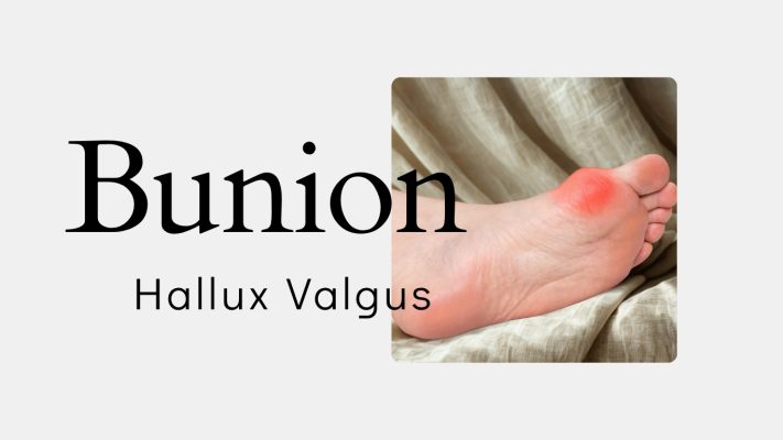 Red swollen bump on foot near the toe, indicating bunion pain or inflammation.