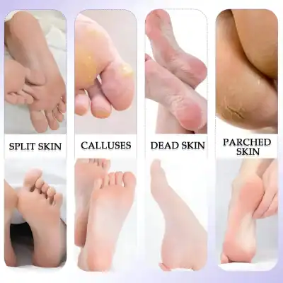 Cracked dry heel skin close-up, foot calluses, dead skin on toes, parched foot skin, plantar keratosis on foot, cracked heels and dry foot care, foot skin exfoliation, foot skincare treatment.