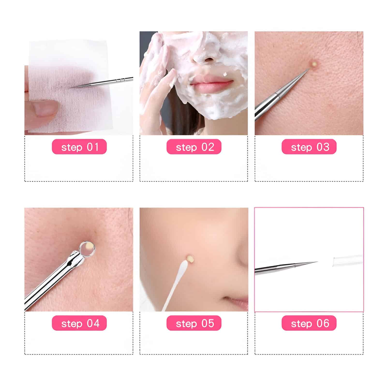 Micro-needling skincare treatment process at Monalisa Medical Store for skin rejuvenation and anti-aging solutions.