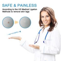 Skin tag removal needle, safe painless dermatology treatment, Monalisa Medical Store opt image.