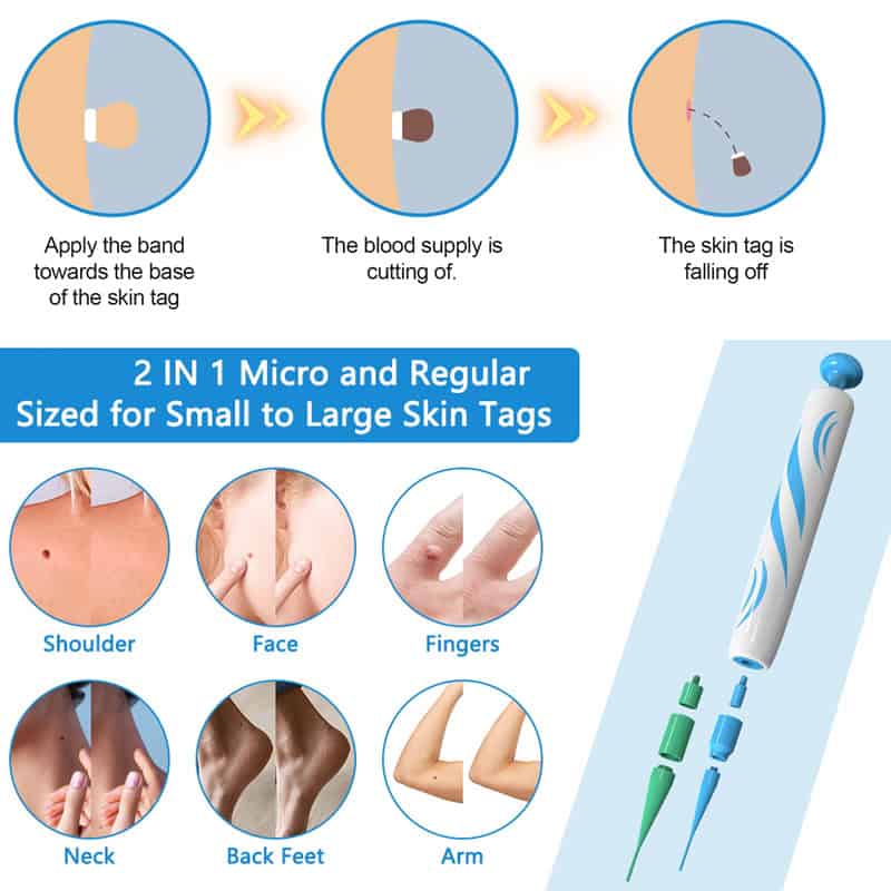 Apply the band towards the base of the skin tag, perfect for skin tag removal, effective for small to large skin tags.