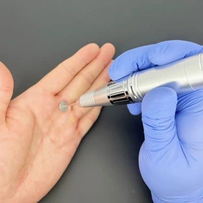 Close-up of a medical professional injecting dermal filler into a patient's hand for youthful appearance.