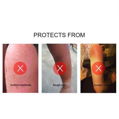 Sunburn erythema, rough skin, and sunburn red on legs.