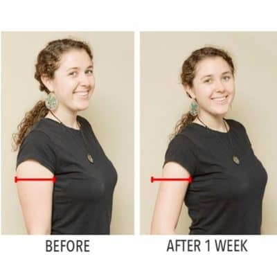 High-quality arm slimming transformation with Monalisa Medical, showcasing the effectiveness of our non-invasive treatments in just 1 week. Perfect for those seeking a slimmer, toned look.