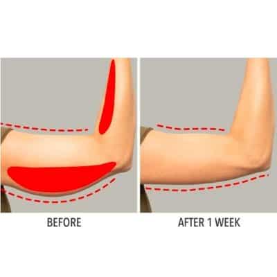Close-up of arm fat reduction before and after one week with Monalisa Medical's non-surgical fat loss solutions.